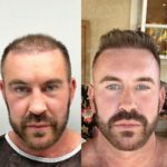 Hair transplant in Turkey