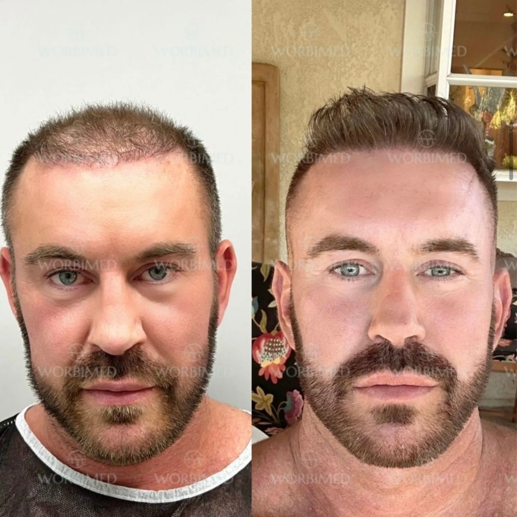 Hair transplant in Turkey