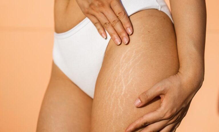 Calculate Your Cellulite Score